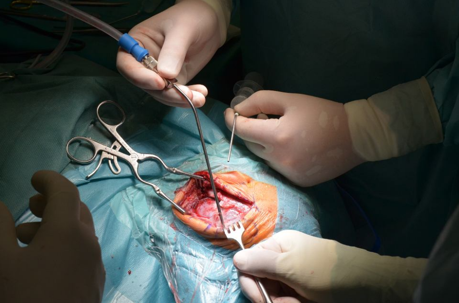 Pierwsza w Polsce operacja wszczepienia implantu pniowego u małego dziecka - 3