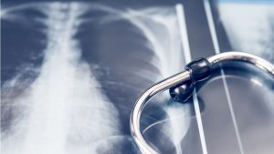Zdjęcie rentgenowskie klatki piersiowej z stetoskopem, symbolizującym diagnostykę medyczną.