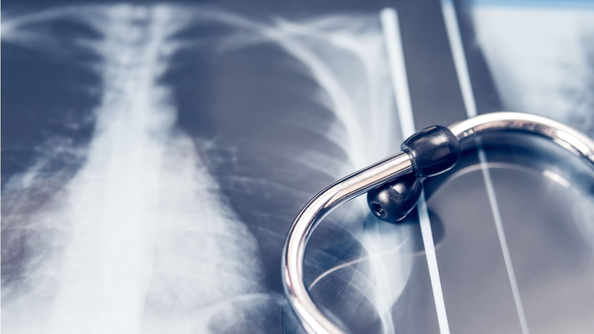 Zdjęcie rentgenowskie klatki piersiowej z stetoskopem, symbolizującym diagnostykę medyczną.
