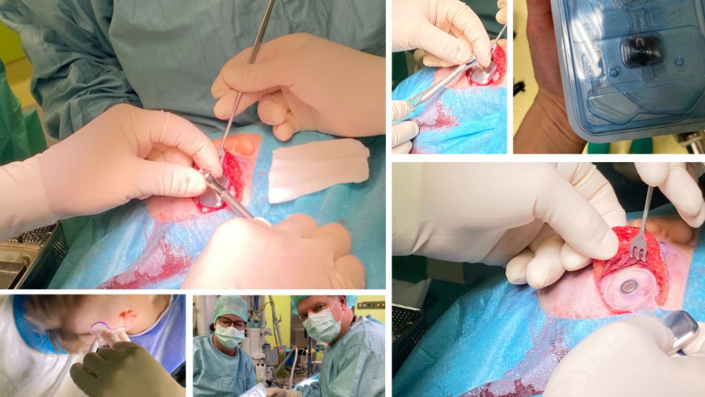 Kolaż zdjęć z przebiegu operacji wszczepienia implantu Cochlear Osia u 5-letniego pacjenta