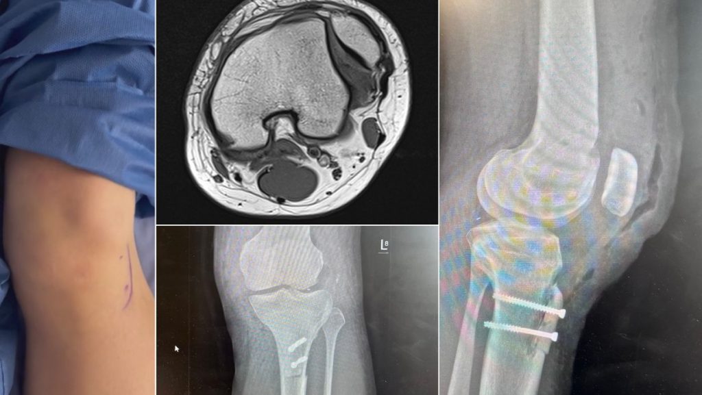 Staw kolanowy – zdjęcie położenia rzepki w wyproście, rezonans magnetyczny stawu przed zabiegiem